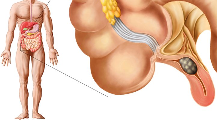 in of causes appendicitis adults