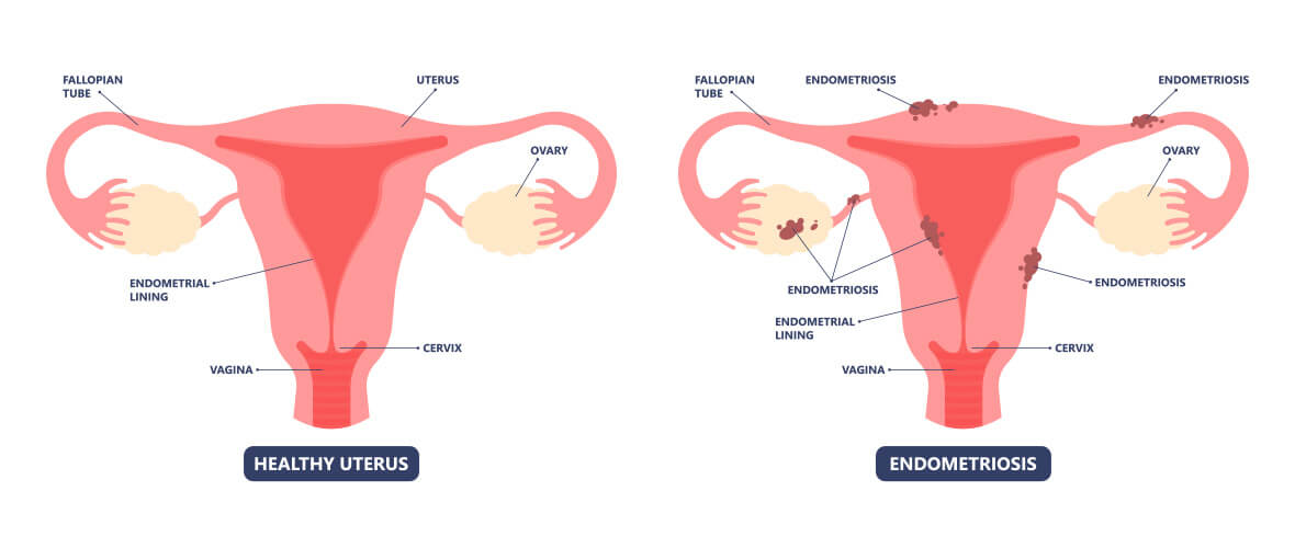 laproscopic endometreosis surgery after vaginal pain