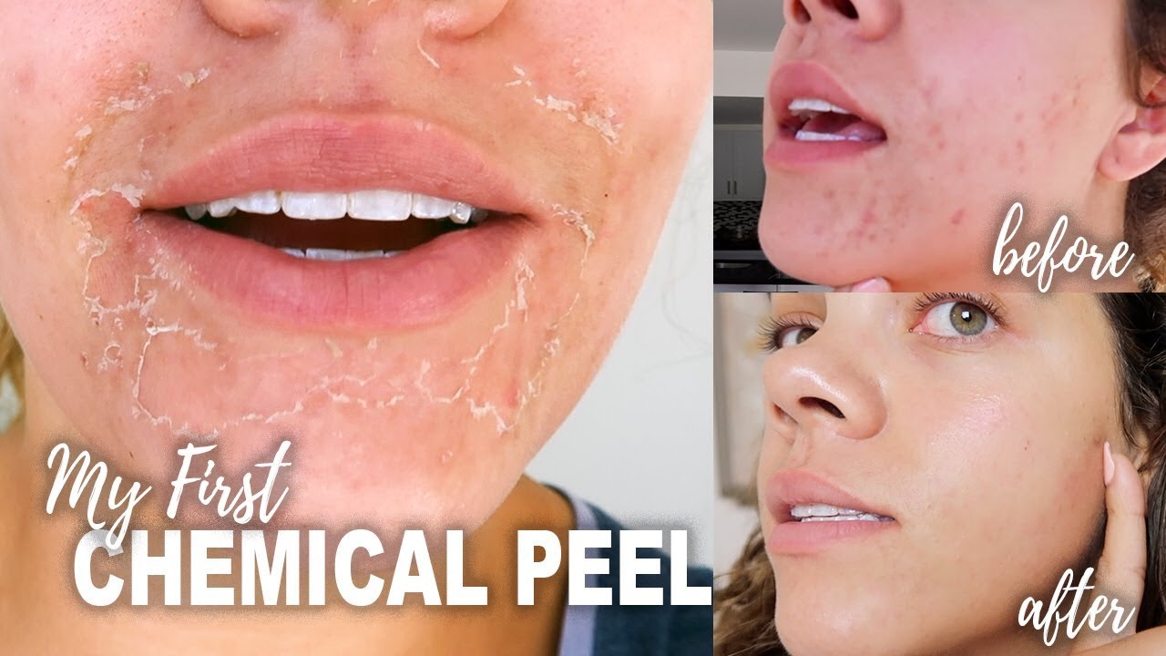 facial skin peel