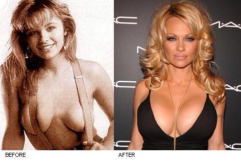 breast pam anderson