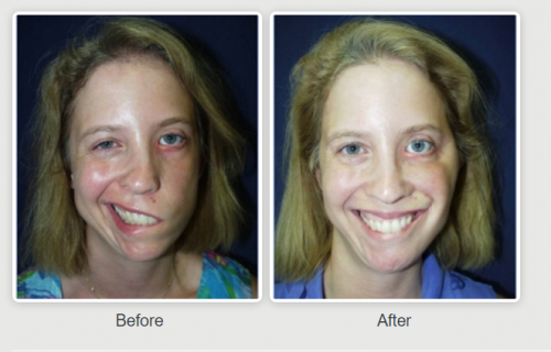surgery facial reanimation
