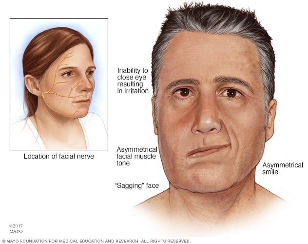 nerve palsy recurrent facial