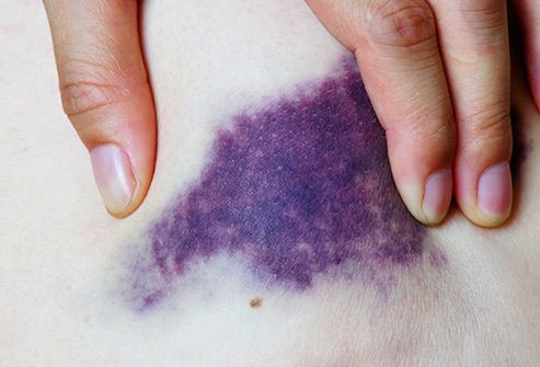 several on purple bruises penis
