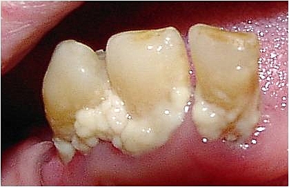 teeth plaque bottom on