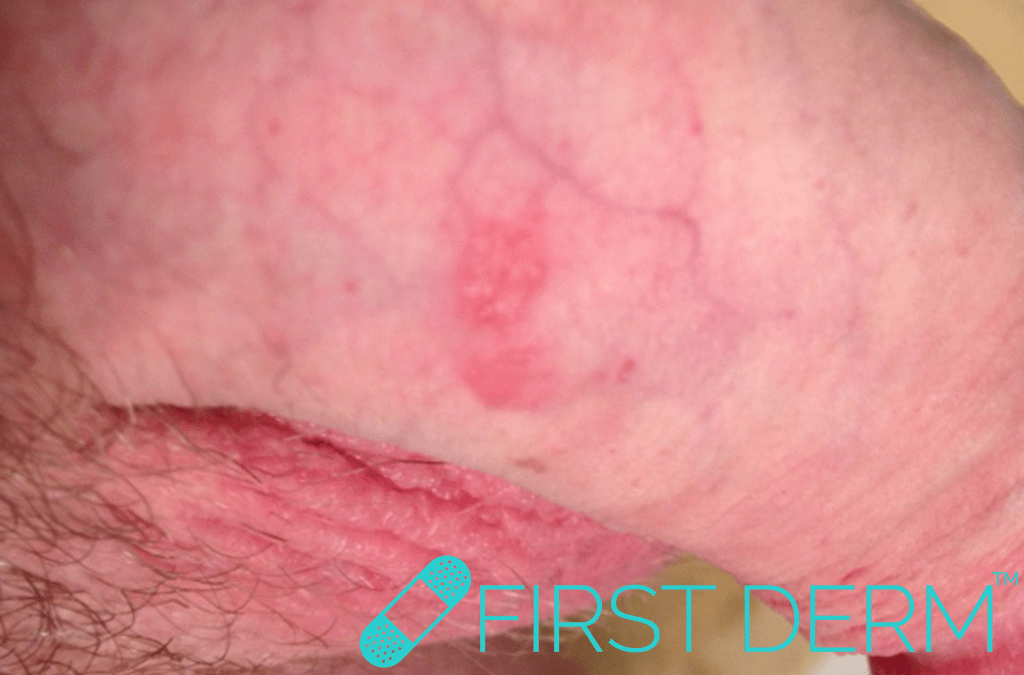 skin anal sex rash