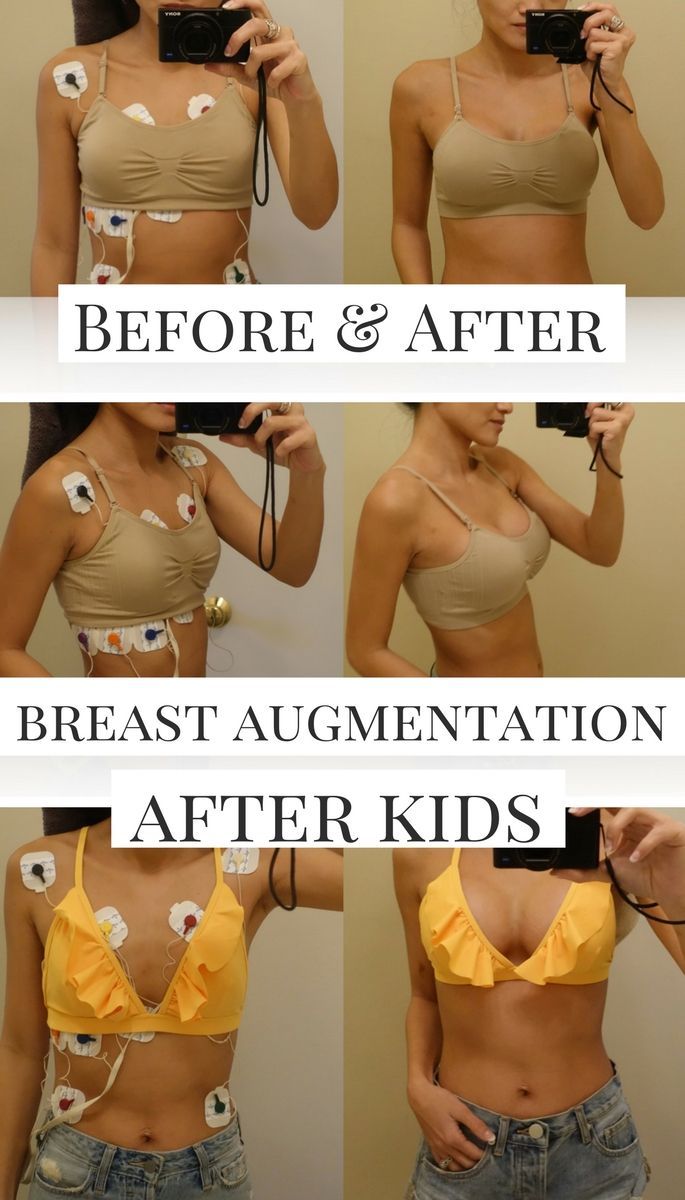 p p implants i breast