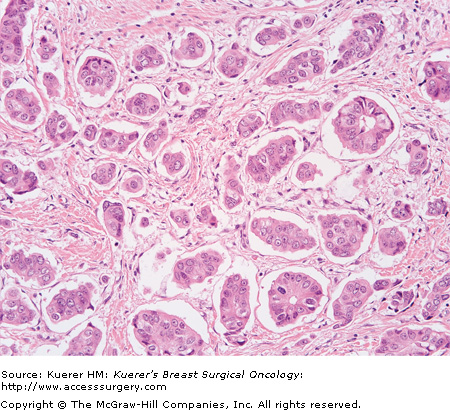 breast micropapillary features cancer focal