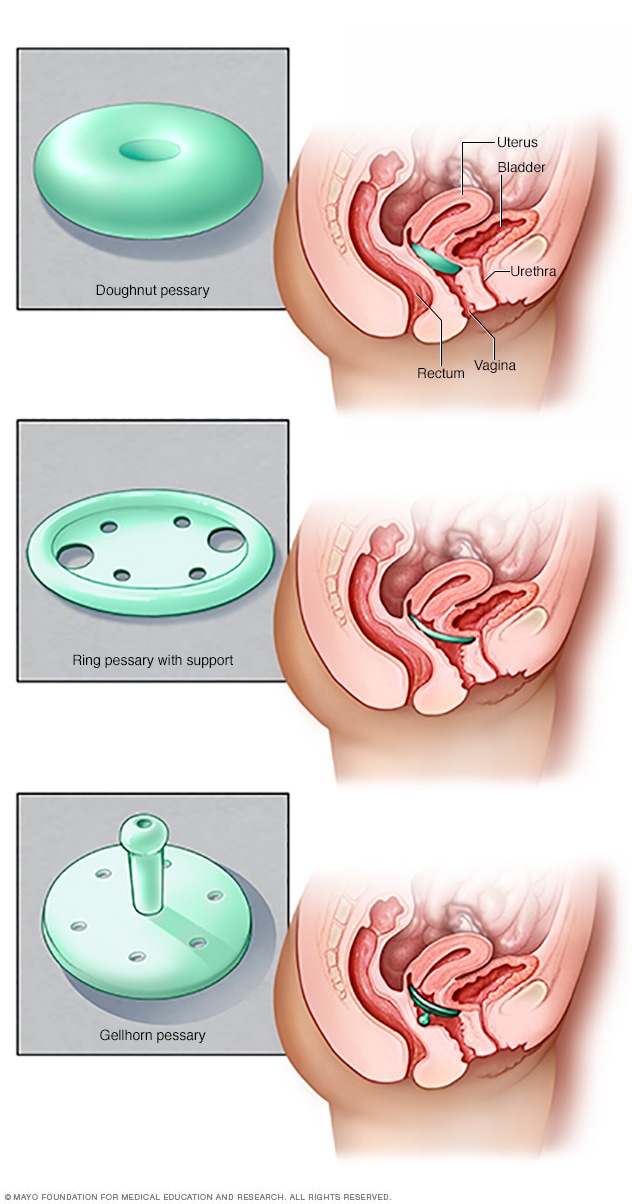 vaginal prolapse cystocele