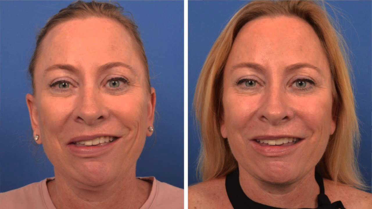 surgery facial reanimation
