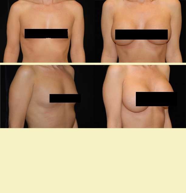 enhancment breast natural surgery